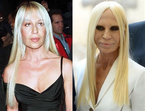 donatella versace before and after plastic surgery|donatella versace face what happened.